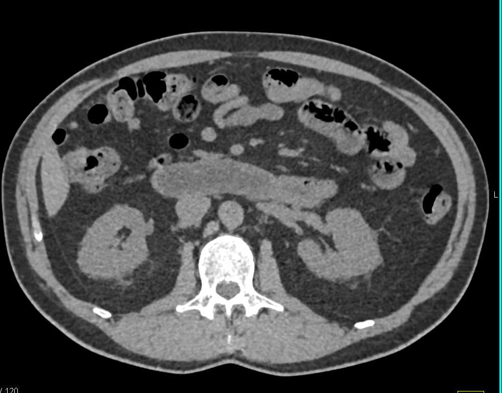 Subtle Neuroendocrine Tumor in the Neck of the Pancreas - CTisus CT Scan