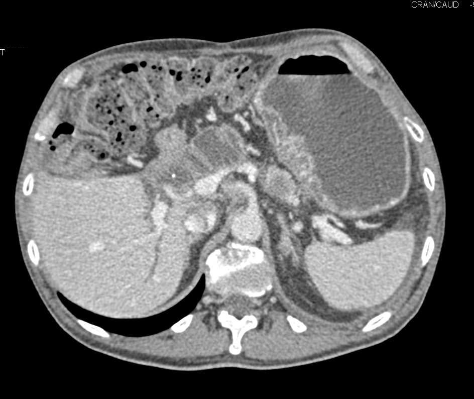 Pancreatic Cancer with Carcinomatosis - CTisus CT Scan