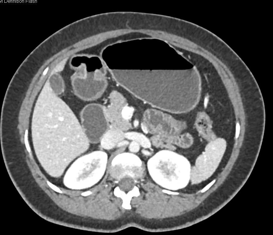 Intraductal Papillary Mucinous Neoplasm (IPMN) in the Head of the Pancreas - CTisus CT Scan