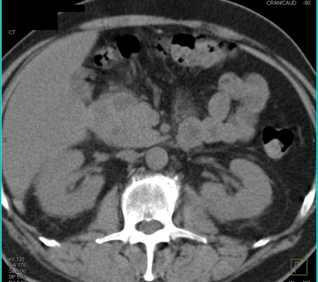 Neuroendocrine Tumor in the Head of the Pancreas - CTisus CT Scan