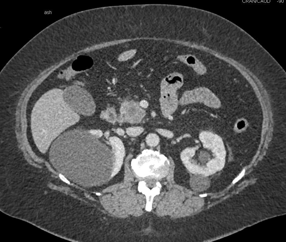 Carcinoma of the Tail of the Pancreas - CTisus CT Scan