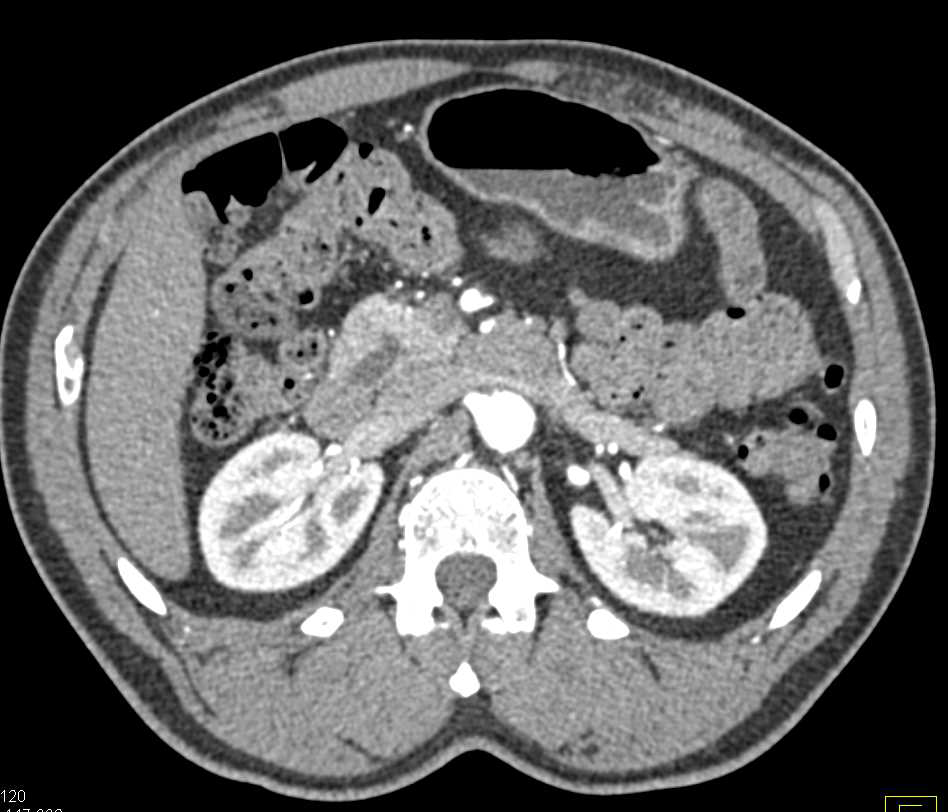 Intraductal Papillary Mucinous Neoplasm (IPMN) in the Head of the Pancreas - CTisus CT Scan