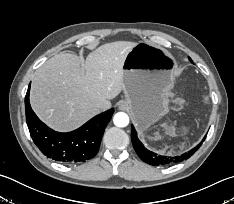 Incidental Neuroendocrine Tumor Pancreas in Patient with Ulcerative Colitis - CTisus CT Scan