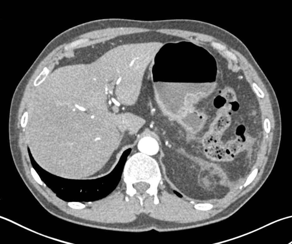 Incidental Neuroendocrine Tumor Pancreas in Patient with Distal Pancreatectomy and Splenectomy - CTisus CT Scan