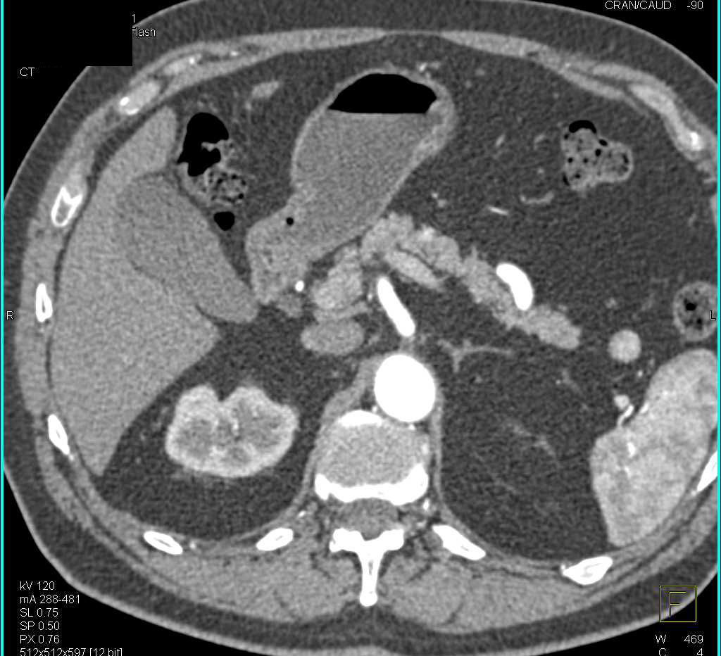 Intraductal Papillary Mucinous Neoplasm (IPMN) Head of Pancreas and Splenule Near Tail of the Pancreas - CTisus CT Scan