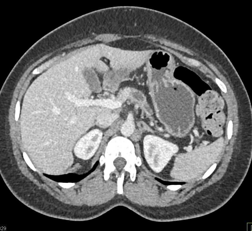 Central Intraductal Papillary Mucinous Neoplasm (IPMN) of the Pancreas with Dysplasia - CTisus CT Scan