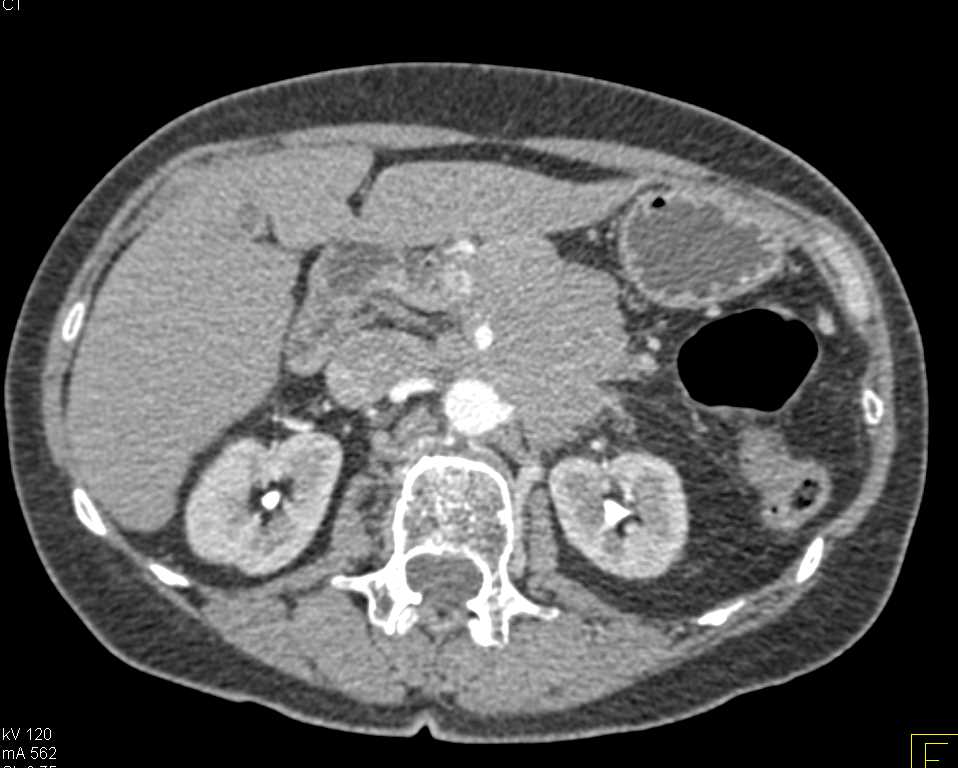 Pancreatic Cancer with Arterial and Venous Invasion - CTisus CT Scan