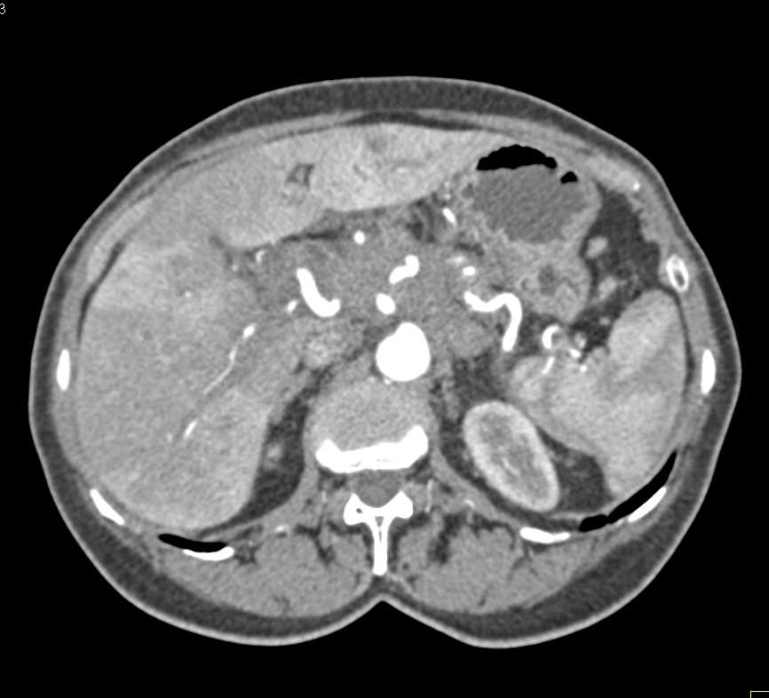 Metastatic Pancreatic Cancer to Liver with Arterial and Venous Encasement - CTisus CT Scan