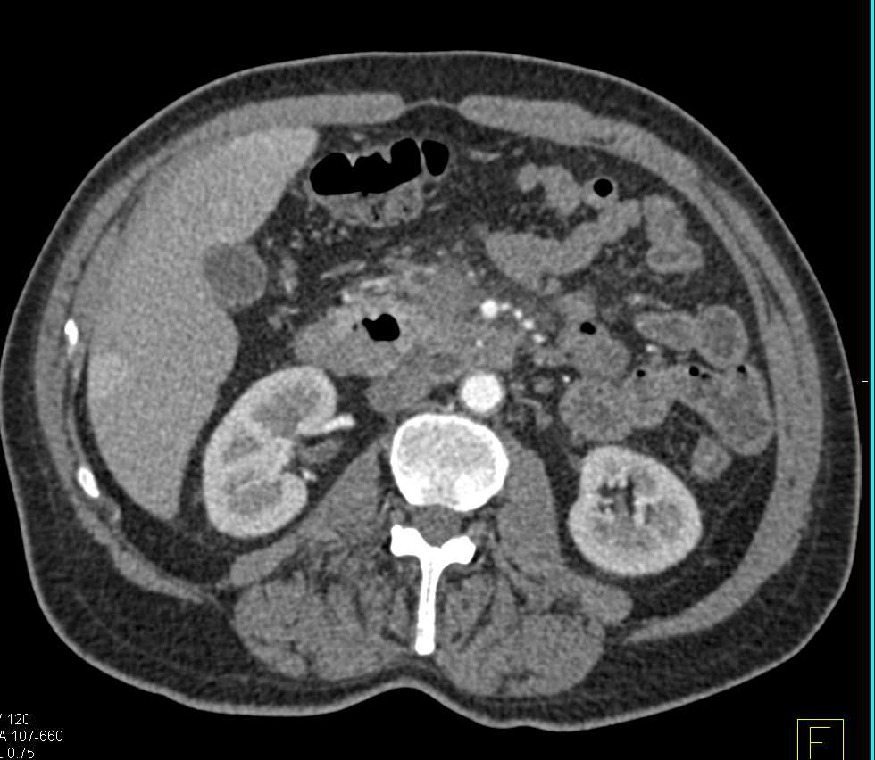 Adenocarcinoma of the Head of the Pancreas with Arterial and Venous Involvement - CTisus CT Scan