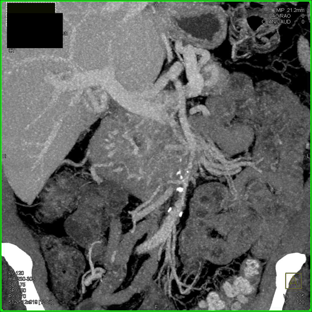 Pancreatic Cancer Occludes the Portal Vein Superior Mesenteric Vein (SMV) Confluence - CTisus CT Scan