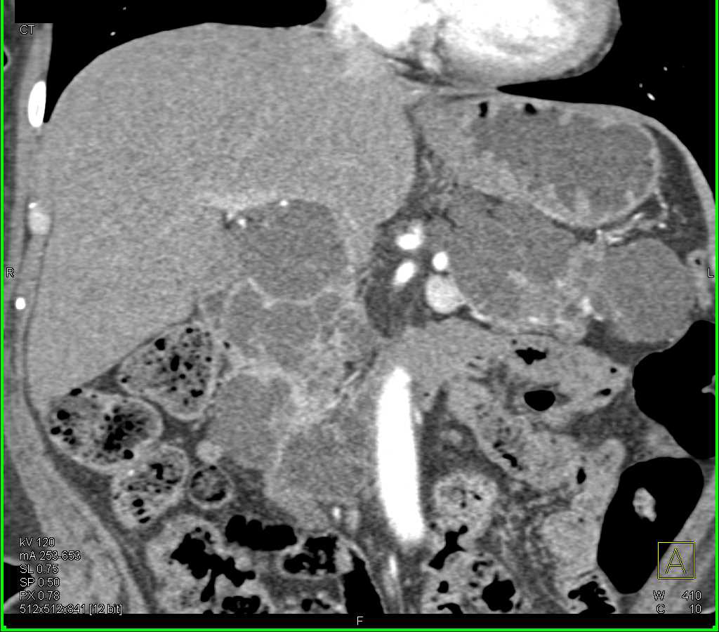 von Hippel Lindau with  Renal Cell Carcinoma and Cysts as well as Pancreatic Cysts - CTisus CT Scan