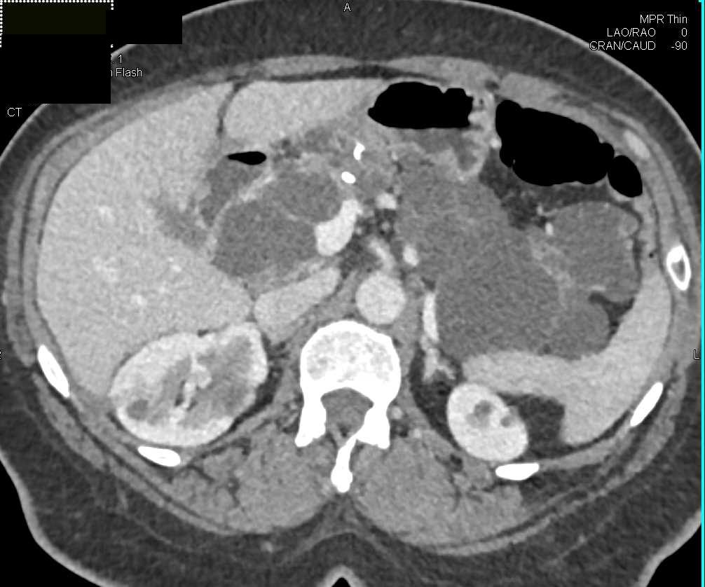 von Hippel Lindau Disease with Multiple Cystic Pancreatic Lesions and Renal Cell Carcinoma and Cysts - CTisus CT Scan