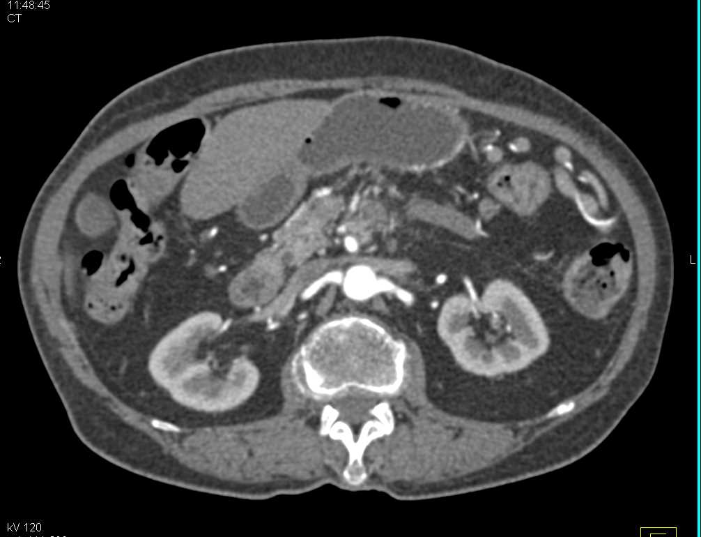 Neuroendocrine Tumor in the Body of the Pancreas - CTisus CT Scan