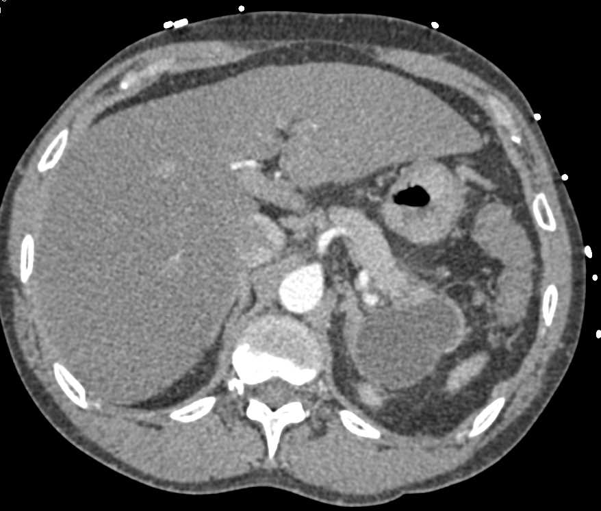 Pseudocyst Involves the Tail of the Pancreas - CTisus CT Scan