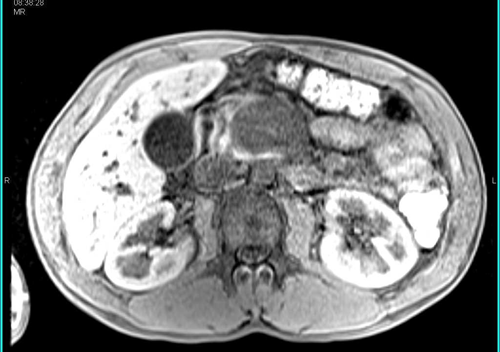 Neuroendocrine Tumor in the Body of the Pancreas - CTisus CT Scan