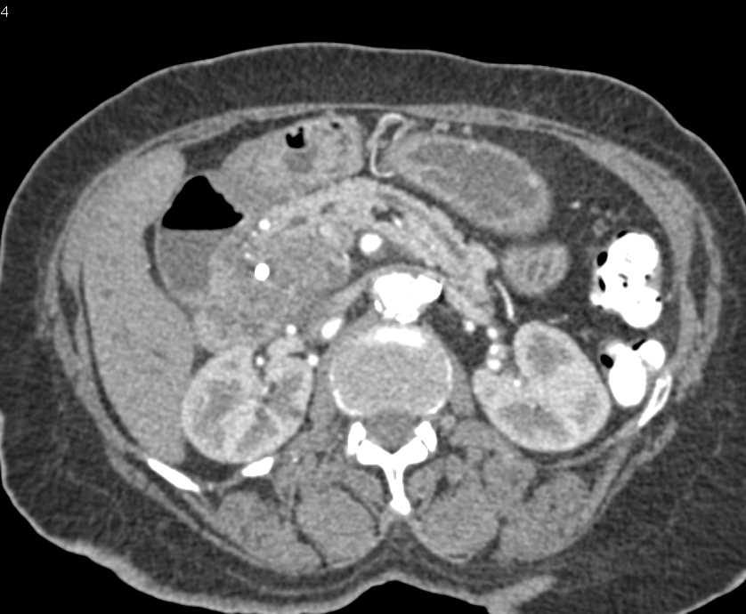 Gastroduodenal Artery (GDA) Pseudoaneurysm with Active Extravasation - CTisus CT Scan