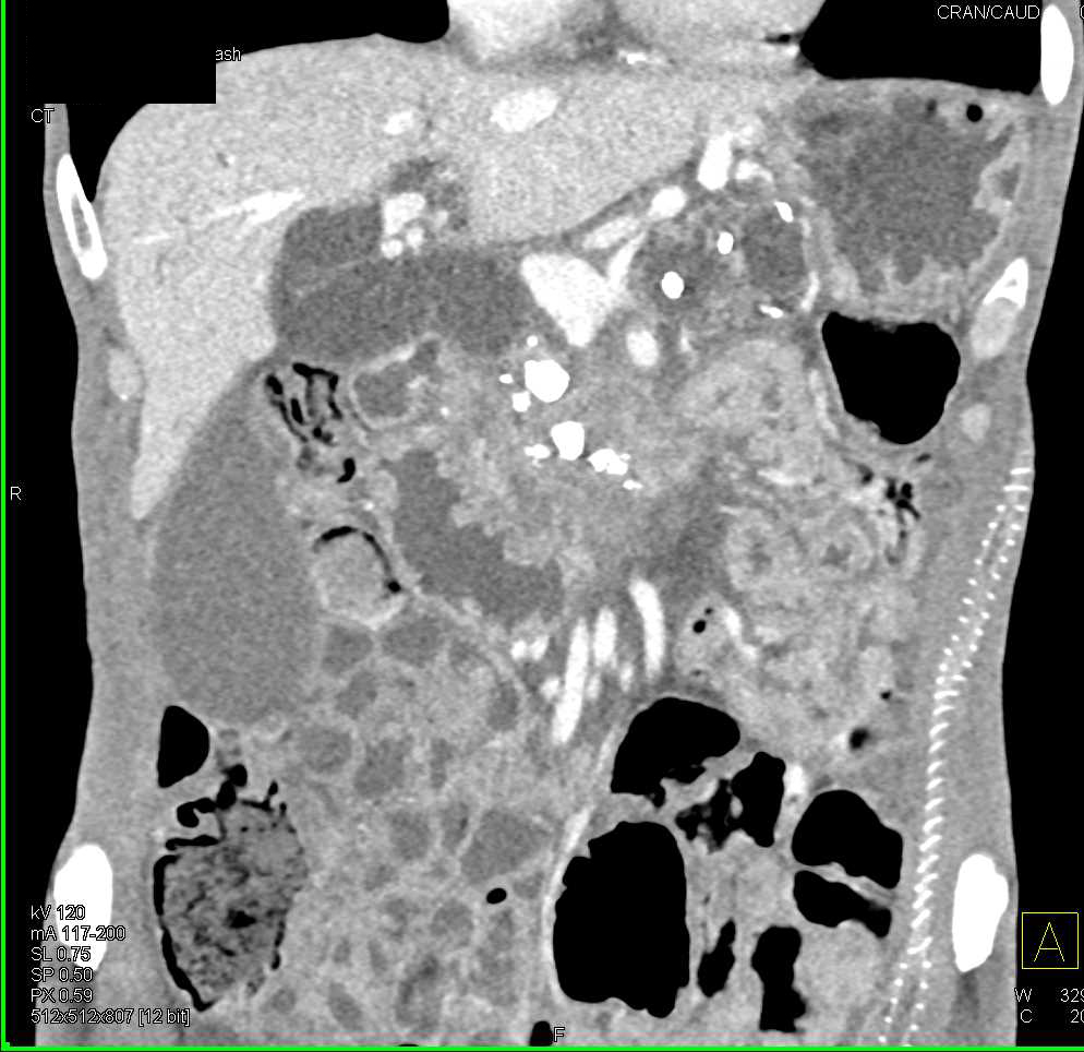 Chronic Pancreatitis - CTisus CT Scan