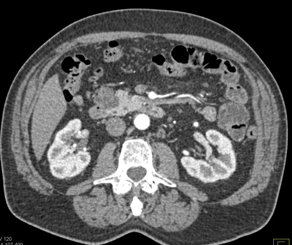 Multiple Pancreatic Intraductal Papillary Mucinous Neoplasms (IPMNs) - CTisus CT Scan