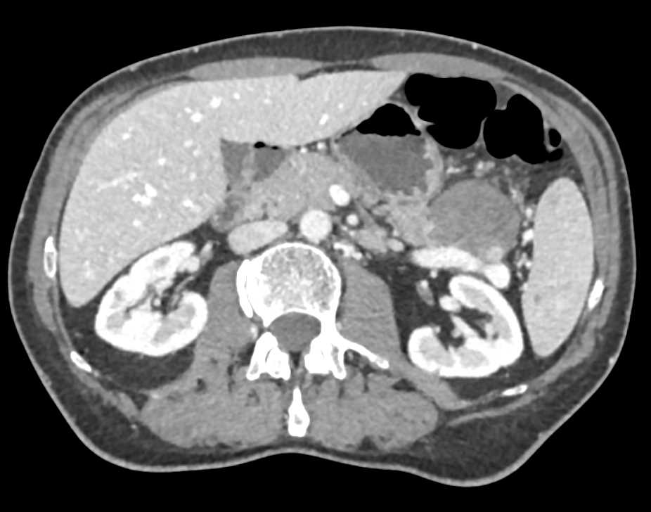 Serous Cystadenoma of the Pancreas - CTisus CT Scan