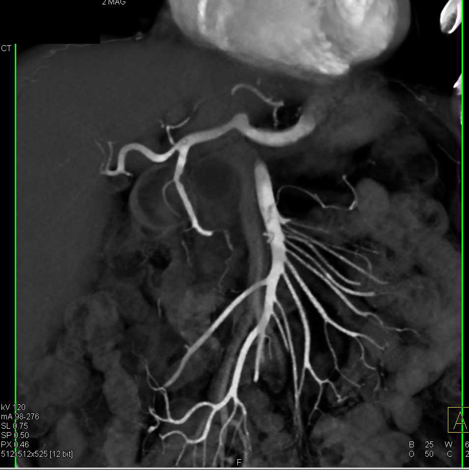 Central Intraductal Papillary Mucinous Neoplasm (IPMN) with High Grade Dysplasia - CTisus CT Scan