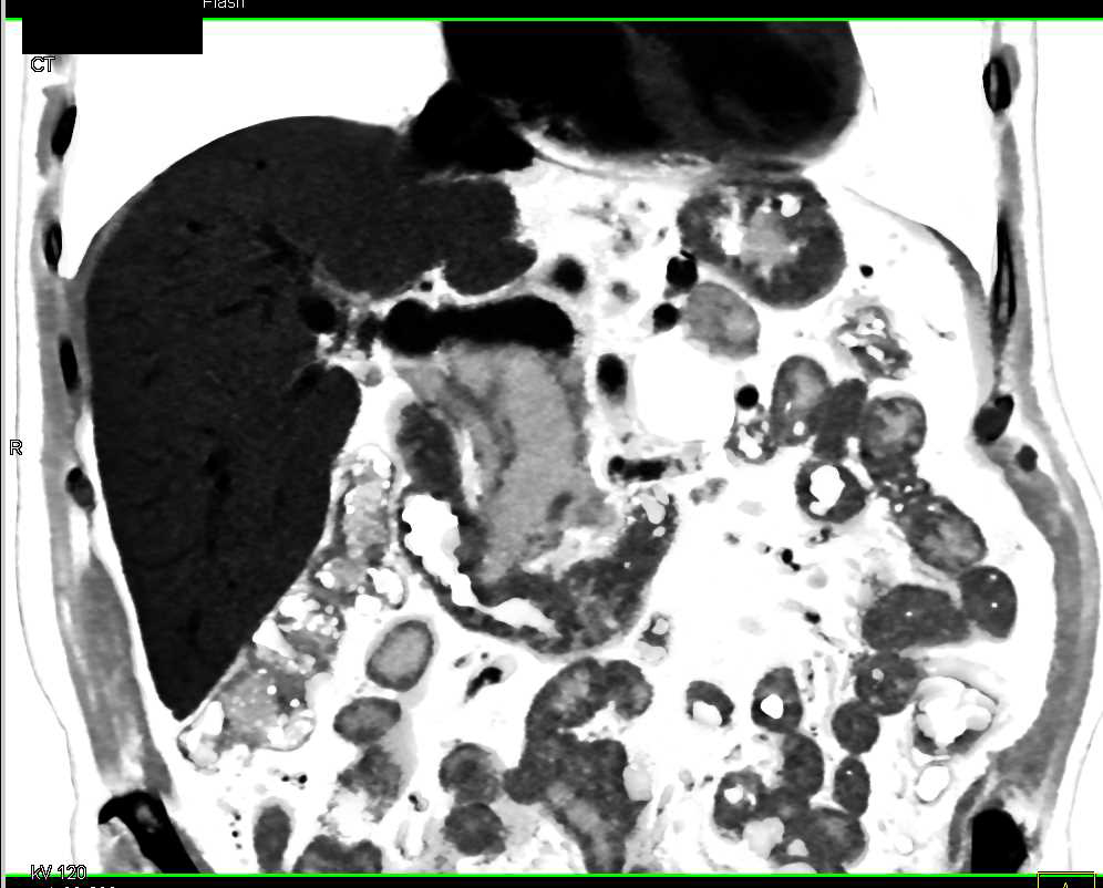 Central Intraductal Papillary Mucinous Neoplasm (IPMN) with High Grade Dysplasia - CTisus CT Scan