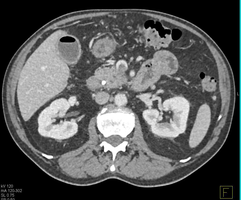 Pancreatic Adenocarcinoma Invades the Superior Mesenteric Vein (SMV) - CTisus CT Scan