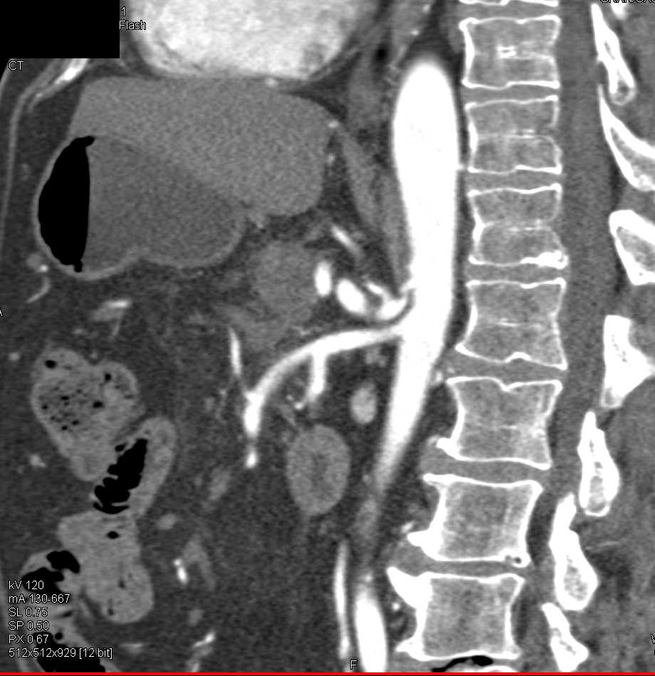 Pancreatic Adenocarcinoma Involving the Arterial and Venous Structures - CTisus CT Scan