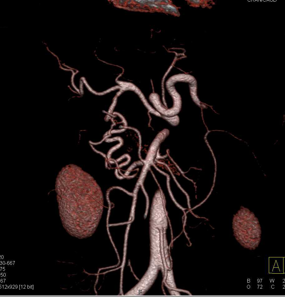 Pancreatic Adenocarcinoma Involving the Arterial and Venous Structures - CTisus CT Scan