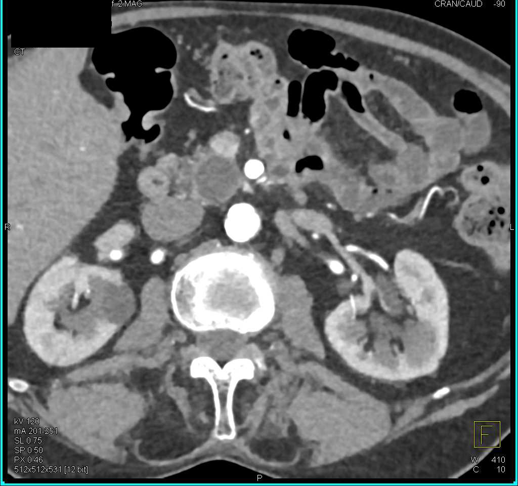 Multiple Intraductal Papillary Mucinous Neoplasms (IPMNs) - CTisus CT Scan