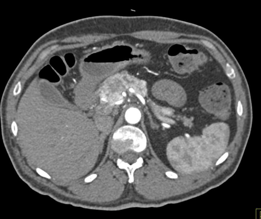 Pancreatic Neuroendocrine Tumor - CTisus CT Scan