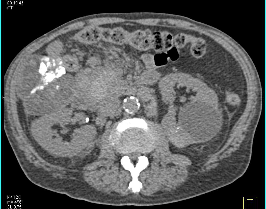 Active Bleed from Gastroduodenal Artery (GDA) in Patient with Recent Procedure - CTisus CT Scan