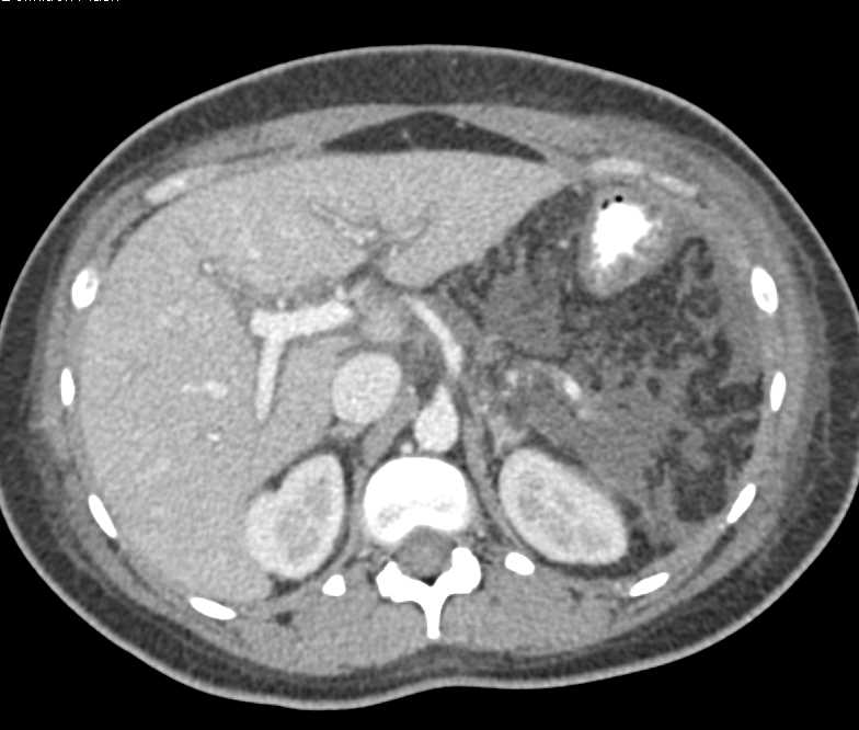 Acute Pancreatitis - CTisus CT Scan