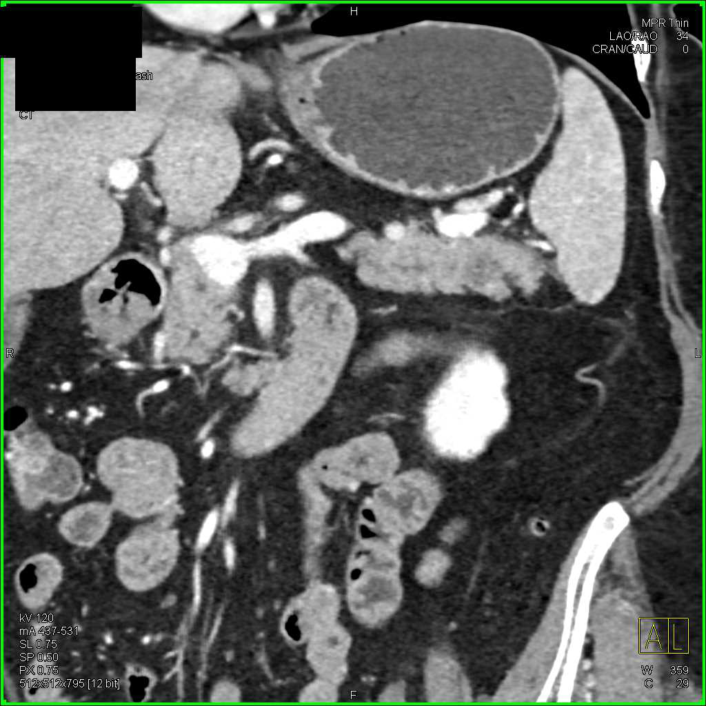 Subtle 1cm Adenocarcinoma of the Pancreas - CTisus CT Scan