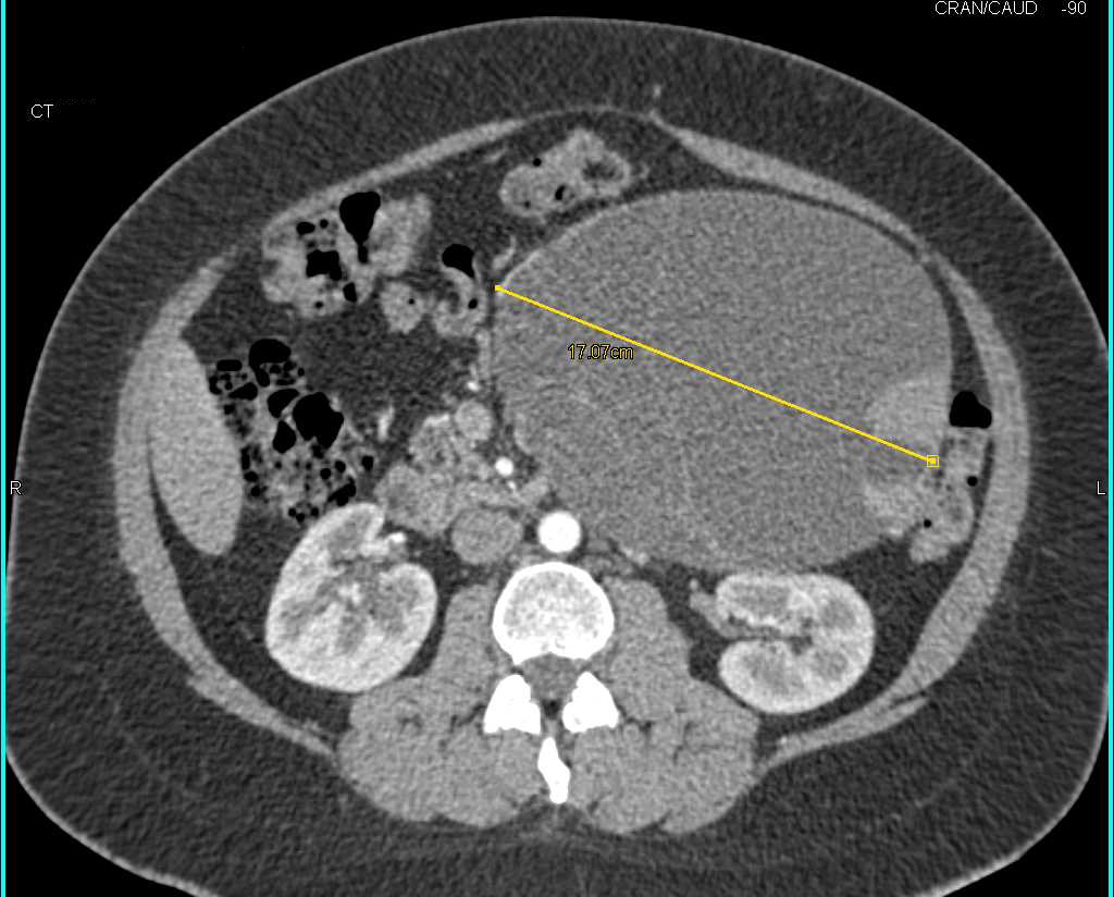 Serous Cystadenoma of the Pancreas - CTisus CT Scan