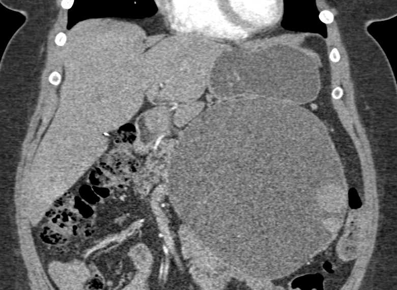 Serous Cystadenoma of the Pancreas - CTisus CT Scan