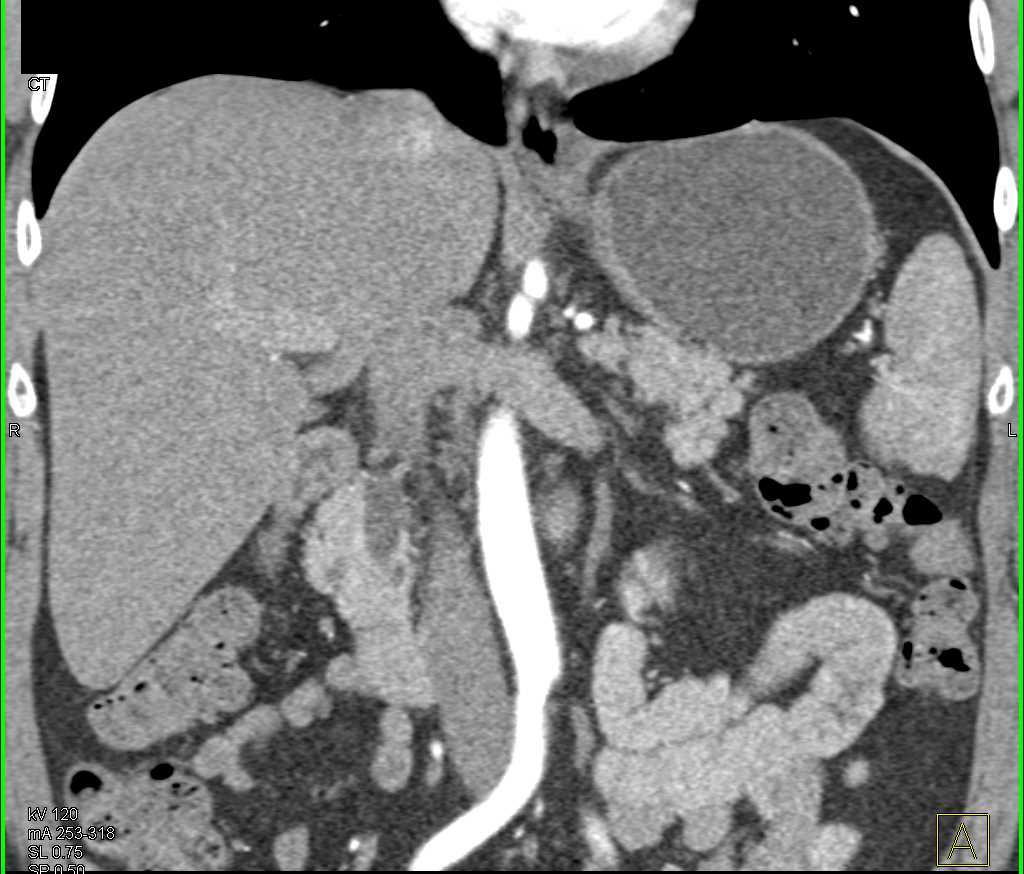 1 cm Ampullary Carcinoma - CTisus CT Scan