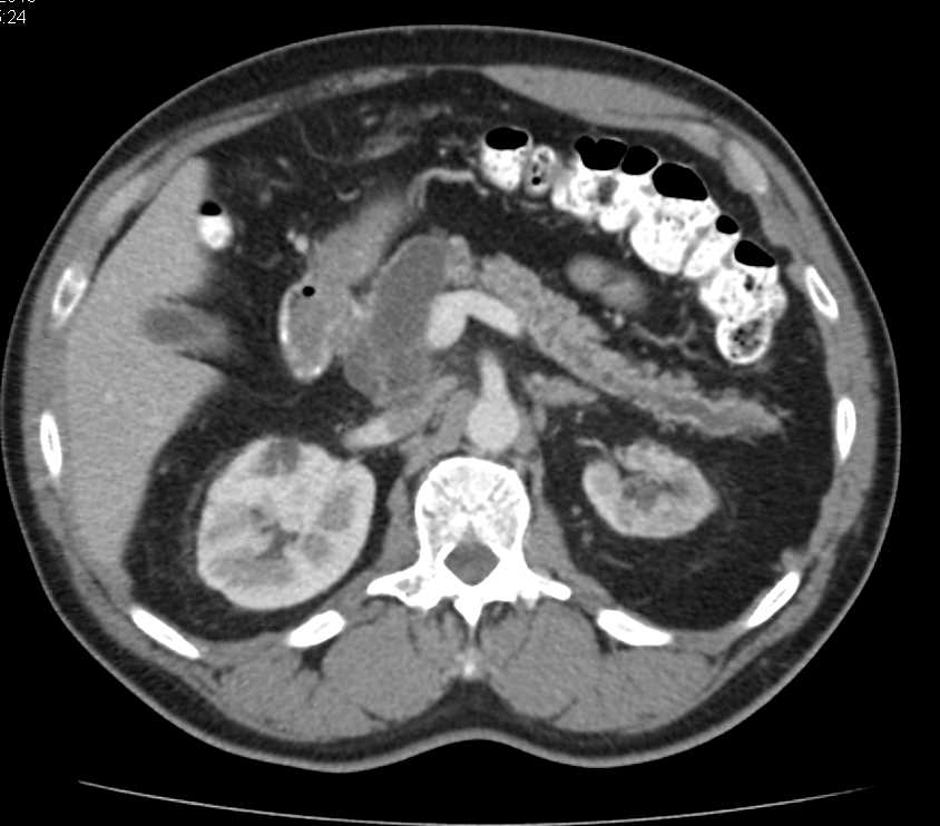 Central Intraductal Papillary Mucinous Neoplasm (IPMN) of the Pancreas with High Grade Dysplasia - CTisus CT Scan