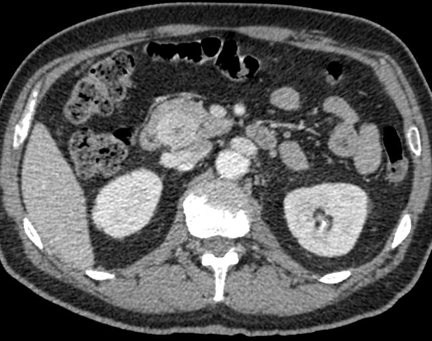 Neuroendocrine Tumor in the Head of the Pancreas - CTisus CT Scan