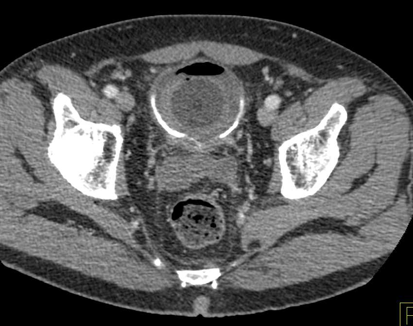 Neuroendocrine Tumor in the Head of the Pancreas and Blood Clot in the Bladder - CTisus CT Scan