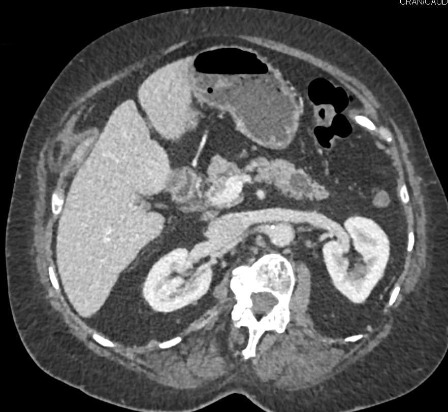 Intraductal Papillary Mucinous Neoplasm (IPMN) Pancreas - CTisus CT Scan