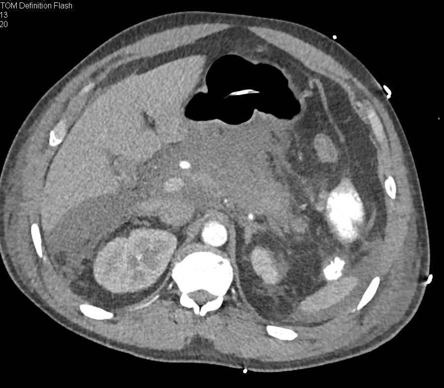 Small Bowel Obstruction due to Pancreatitis - CTisus CT Scan