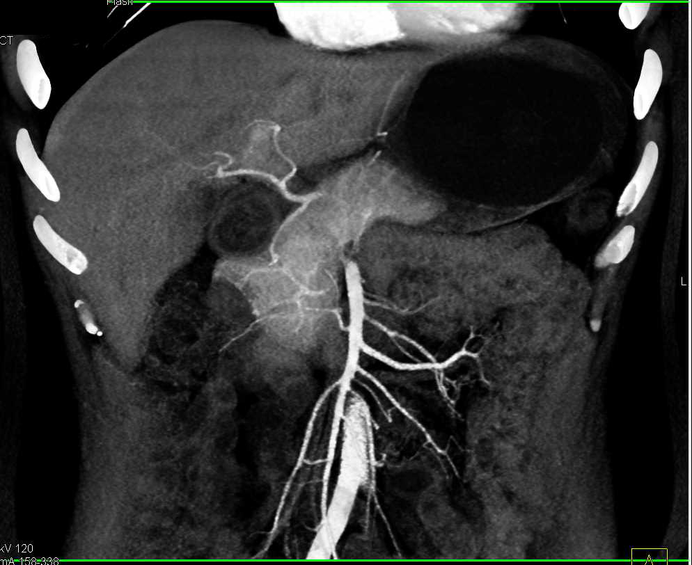 Pancreatic Adenocarcinoma Without Duct Dilatation - CTisus CT Scan