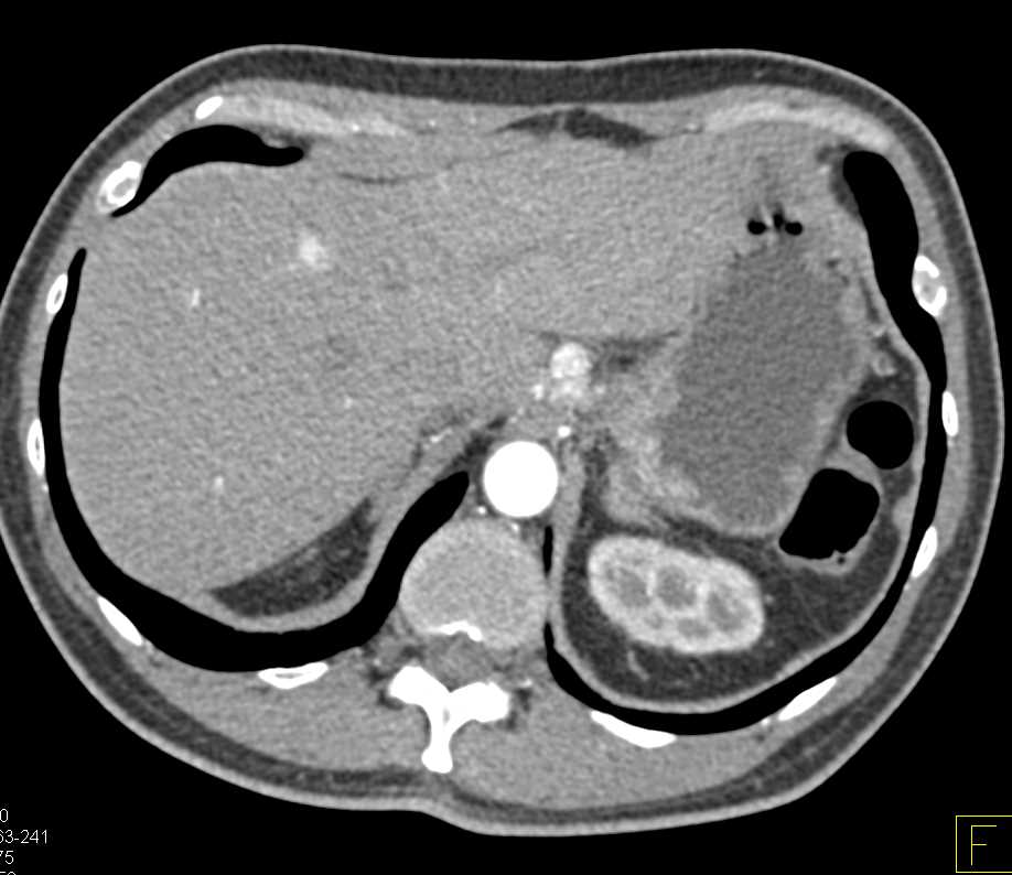 Neuroendocrine Tumor in the  Pancreas with Vascular Liver Metastases and Adenopathy - CTisus CT Scan