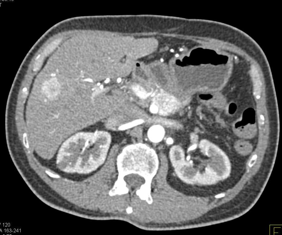 Neuroendocrine Tumor in the  Pancreas with Vascular Liver Metastases and Adenopathy - CTisus CT Scan