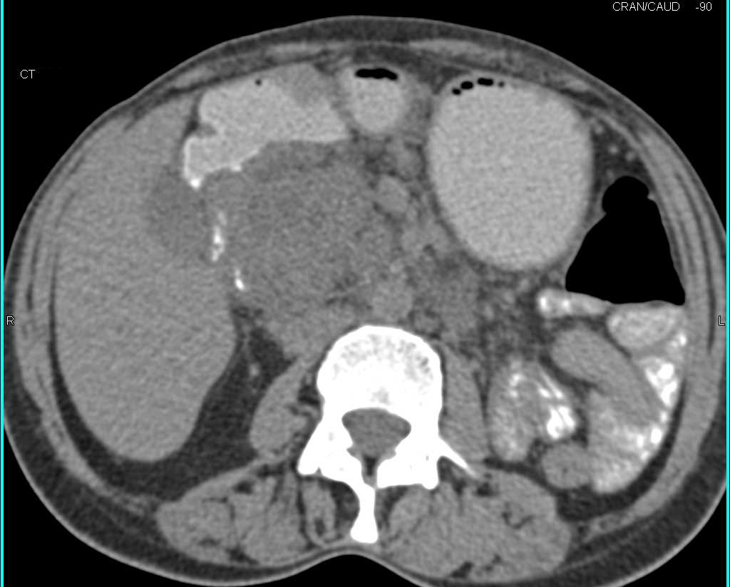 Lymphoma Simulates a Pancreatic Mass in an End Stage Renal Disease (ESRD) Patient - CTisus CT Scan