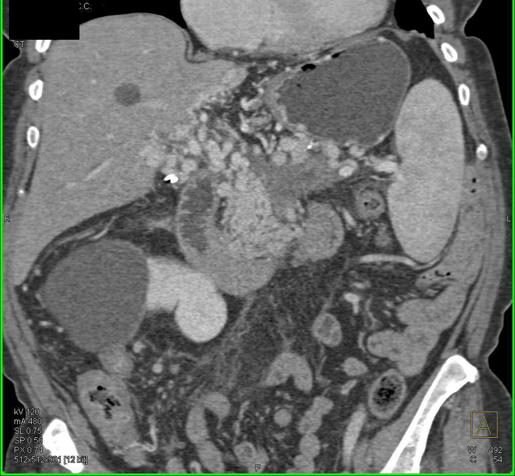 Pancreatic Carcinoma with Cavernous Transformation of the Portal Vein (CTPV) - CTisus CT Scan