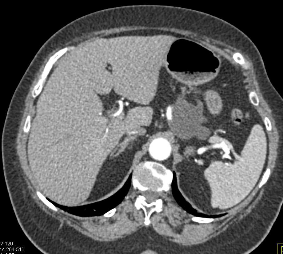 MCN (Mucinous Cystic Neoplasm) of the Pancreas - CTisus CT Scan