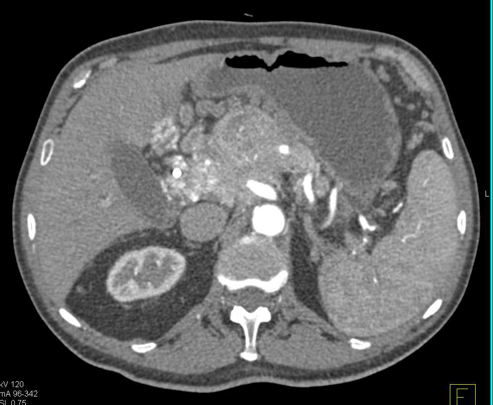 Neuroendocrine Tumor Pancreas with Vascular Involvement - CTisus CT Scan