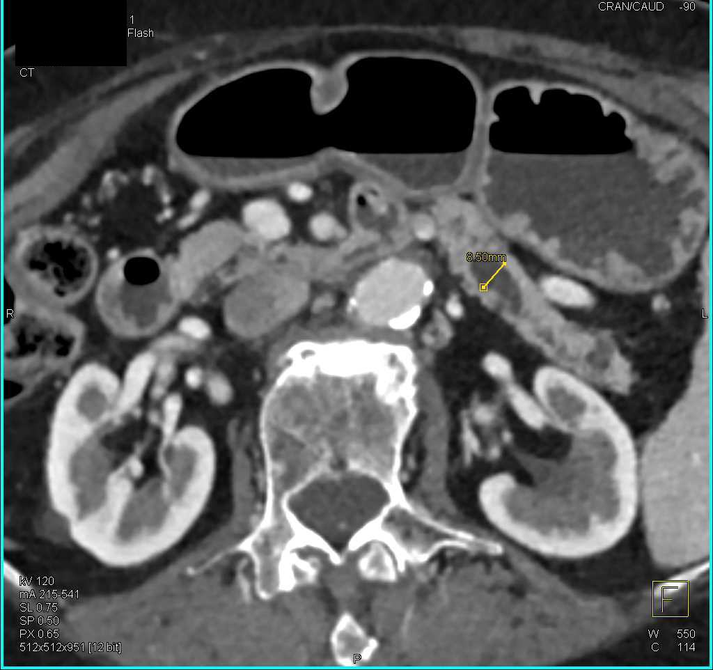 Main Duct Intraductal Papillary Mucinous Neoplasm (IPMN) - CTisus CT Scan