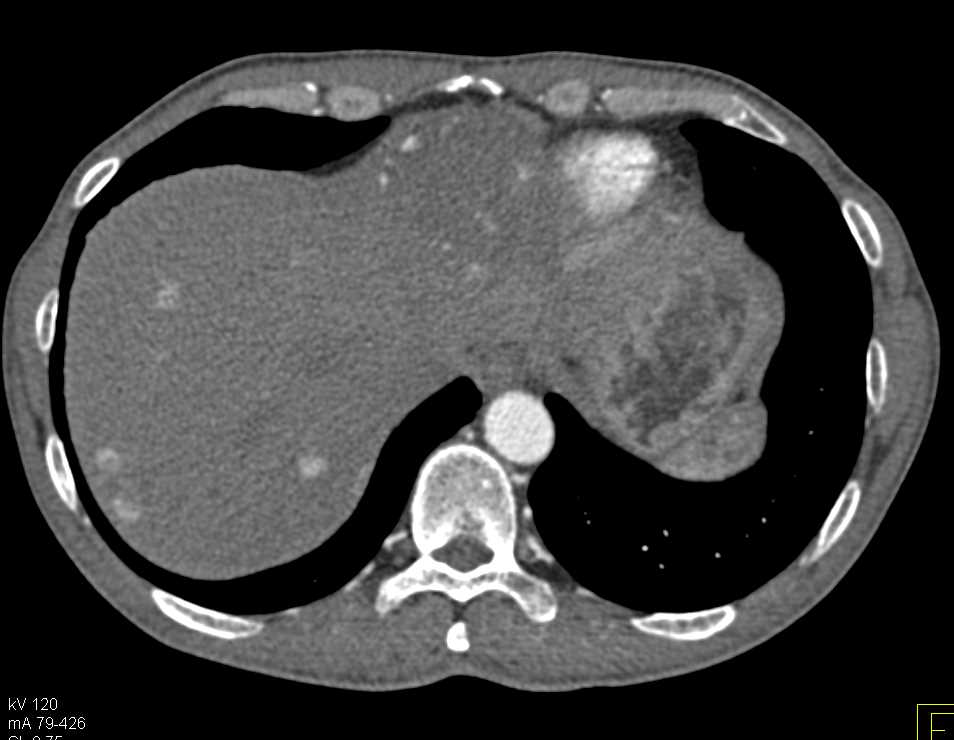 Pancreatic Neuroendocrine Tumor with Liver Metastases - CTisus CT Scan